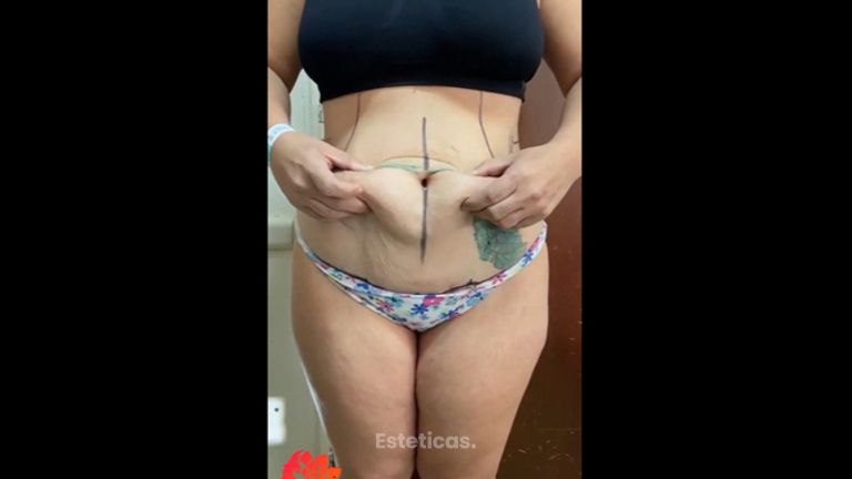 Abdominoplastia - Dr. Emmanuel Manavela Chiapero