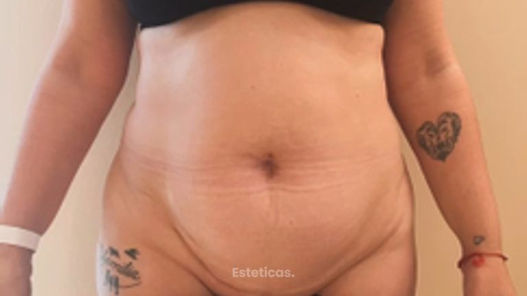 Abdominoplastia - Dra. María Victoria Rodríguez