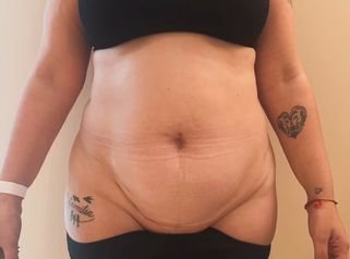 Abdominoplastia - Dra. María Victoria Rodríguez