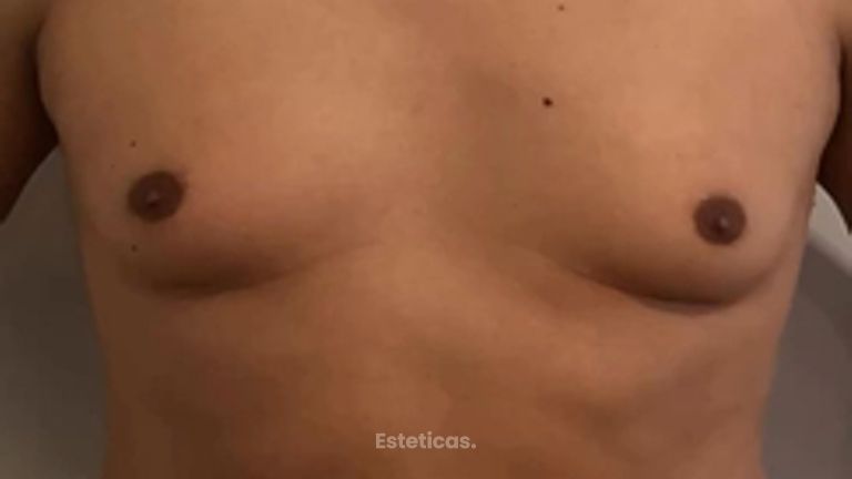 Ginecomastica - Dra. María de la Paz Vélez