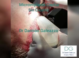 Microimplante Capilar - Sin Cicatriz
