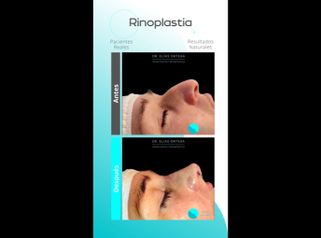 Rinoplastia - Dr. Elias Ortega