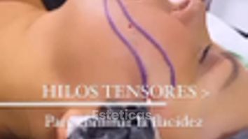 Hilos tensores 20D - Dra. Anahi Versace