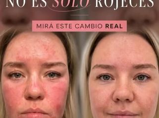 Rosácea - Dra. Jimena D. Frasso