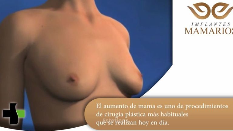 IMPLANTES MAMARIOS - KORPER Medicina Estética