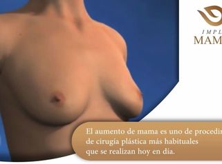 IMPLANTES MAMARIOS - KORPER Medicina Estética