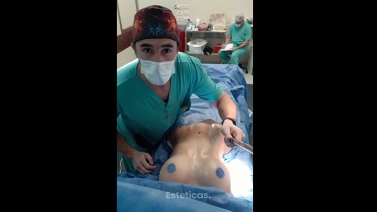 Lipoescultura - Dr. Damián Galeazzo