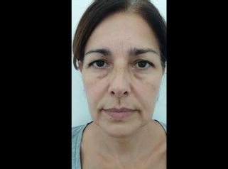 Cirugía Parpados y Minilifting - Dra. Adriana Ratto
