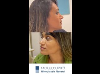 Rinoplastia - Dr. Miguel Ángel Cupito