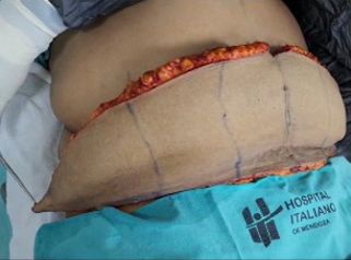 Lipo Abdominoplastia - Dr. Javier Nicolia