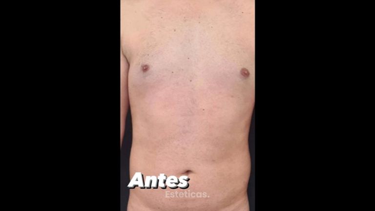 Abdominoplastia - Dra. Paola León