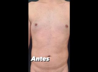 Abdominoplastia - Dra. Paola León