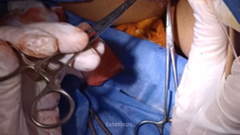 Labioplastia con laser - Dra. Adriana Ratto