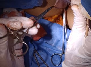Labioplastia con laser - Dra. Adriana Ratto
