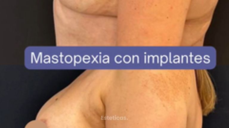 Mastopexia - Dr. Agustín Matia