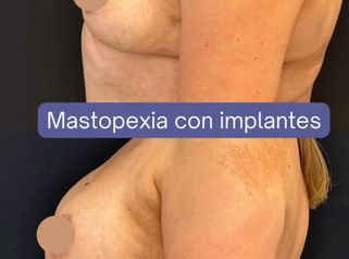 Mastopexia - Dr. Agustín Matia