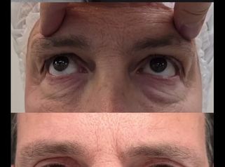 Blefaroplastia - Cirugia de Párpados - Dr. Damián Galeazzo y Equipo