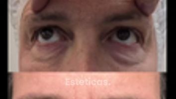 Blefaroplastia - Cirugia de Párpados - Dr. Damián Galeazzo y Equipo