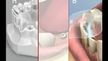 Simulación 3d colocacion de implantes