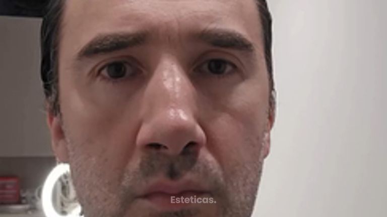 Blefaroplastia exceso de Piel - Dr. Damián Galeazzo y Equipo