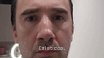 Blefaroplastia exceso de Piel - Dr. Damián Galeazzo y Equipo