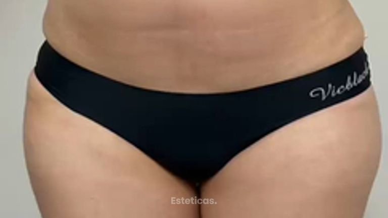 Marcación Abdominal - Dr. Rodolfo Villavicencio