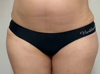 Marcación Abdominal - Dr. Rodolfo Villavicencio