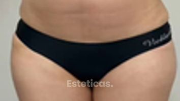 Marcación Abdominal - Dr. Rodolfo Villavicencio