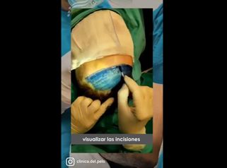 Implante capilar - Dr. Damián Galeazzo Y Equipo
