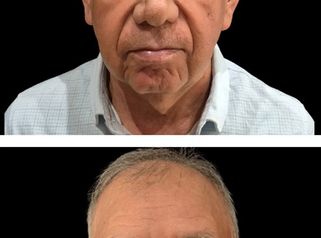 Lifting Facial - Dr. Damián Wengrowicz