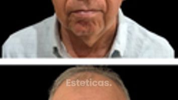 Lifting Facial - Dr. Damián Wengrowicz
