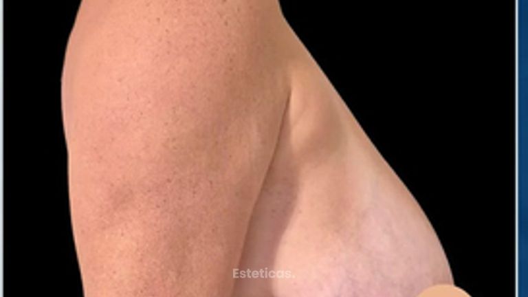 Reducción de mamas - Dr. Damián Wengrowicz