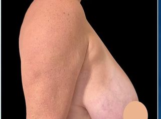 Reducción de mamas - Dr. Damián Wengrowicz