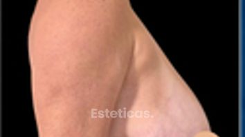 Reducción de mamas - Dr. Damián Wengrowicz