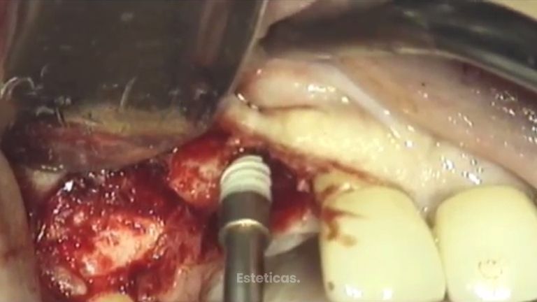 Los implantes mejoran tu dentadura