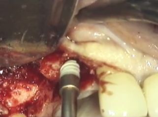 Los implantes mejoran tu dentadura