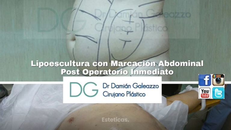 Abdominoplastías.