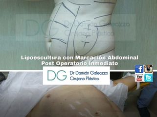 Abdominoplastías.