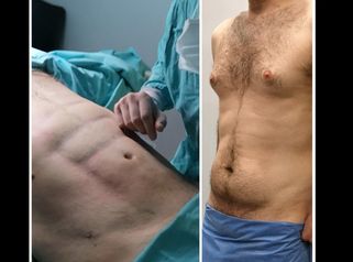 Marcación abdominal