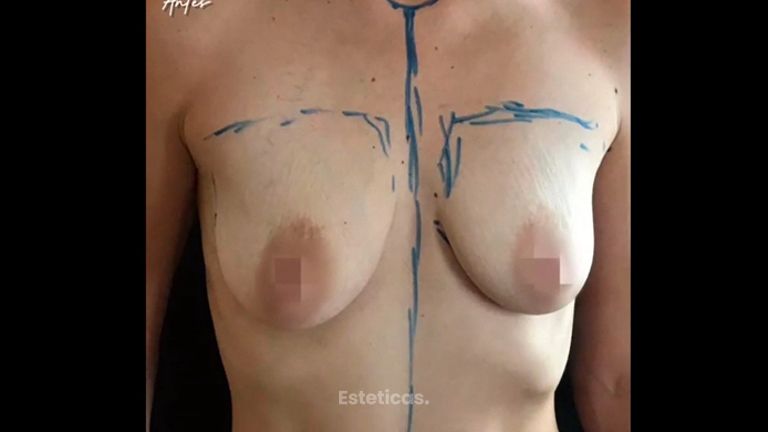 Mastopexia - Dr. Javier Vera Cucchiaro