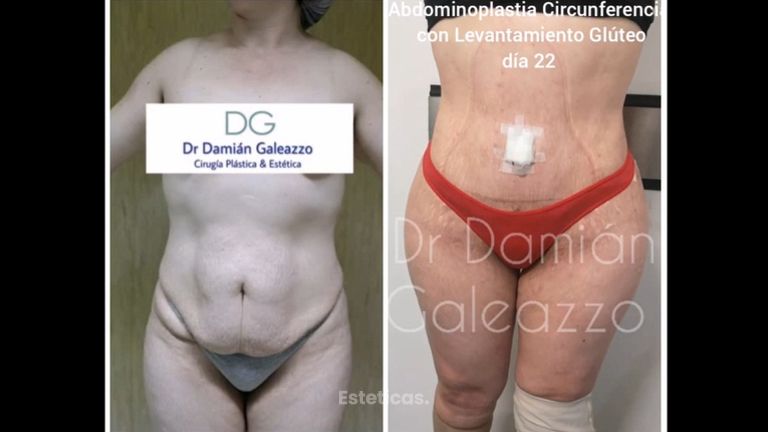 Abdominoplastia 