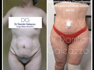 Abdominoplastia 