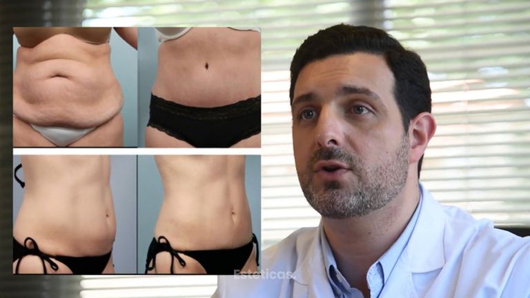 Abdominoplastia 