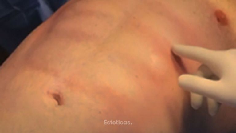 Lipoescultura con marcación abdominal - Galeazzo Cirugia & Estetica