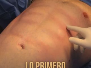 Lipoescultura con marcación abdominal - Galeazzo Cirugia & Estetica