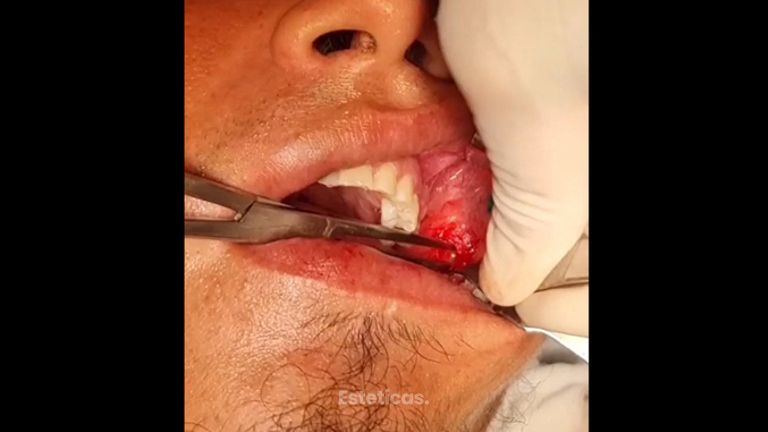 Bichectomia - Dr. Javier Nicolía - Centro Médico Palmares