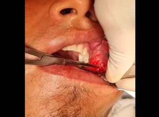 Bichectomia - Dr. Javier Nicolía - Centro Médico Palmares