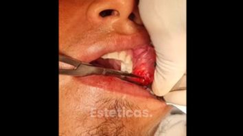 Bichectomia - Dr. Javier Nicolía - Centro Médico Palmares