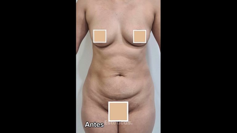 Abdominoplastia - Dra. Paola León
