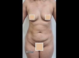 Abdominoplastia - Dra. Paola León
